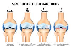 Osteoarthritis