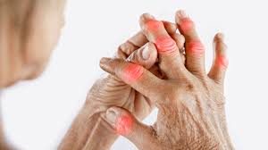 Rheumatoid Arthritis