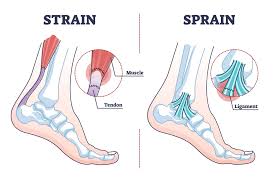 Sprain or Strain